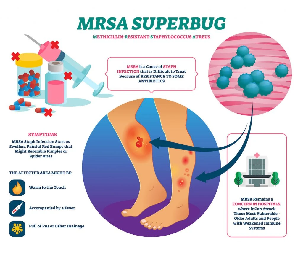 MRSA Infections in Nursing Homes & Care Living Facilities